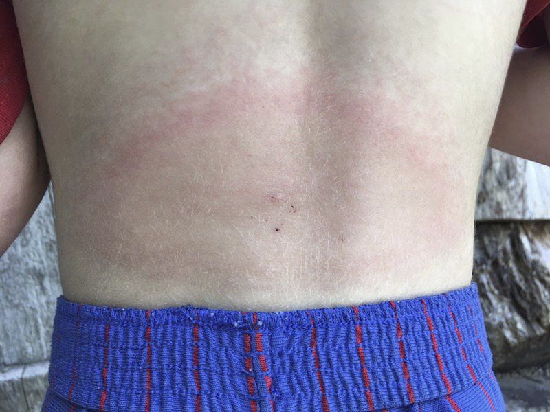 Pediatrician encounters tick bites, Lyme disease